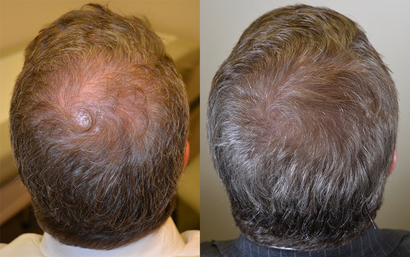 Before and after