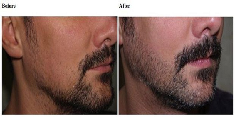 Before and after