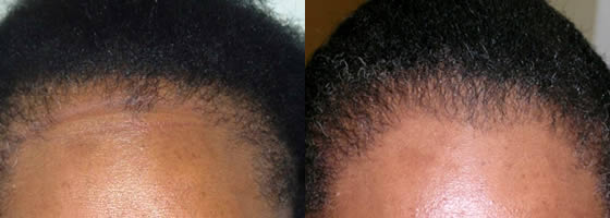 Before and after